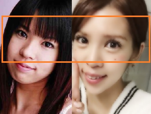 目頭切開＿坂口杏里