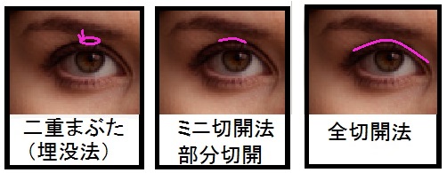 美容整形_目_012